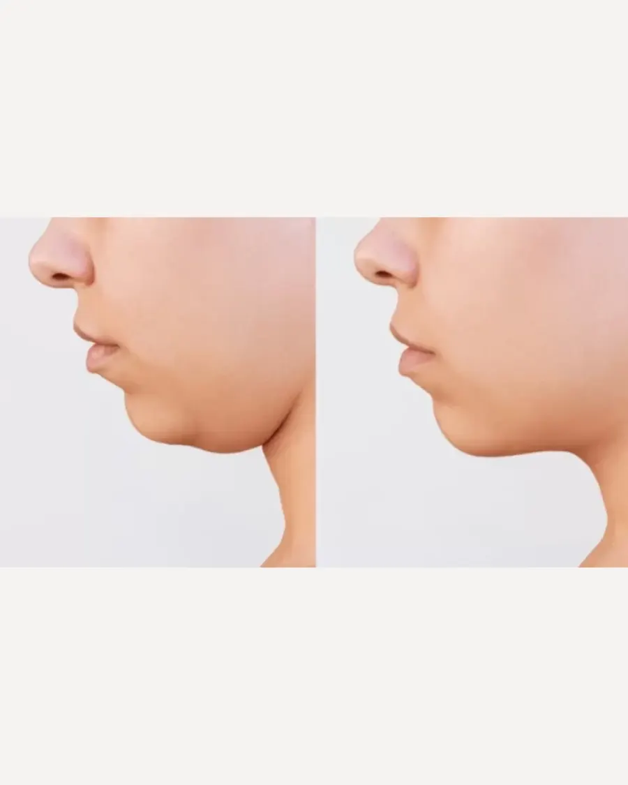 Advanced Non-Surgical Fat Reduction for the Chin Area at Cinch Clinics